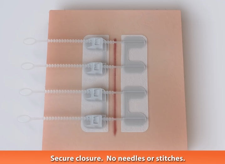 Zipstitch- Advanced Wound Closure Device